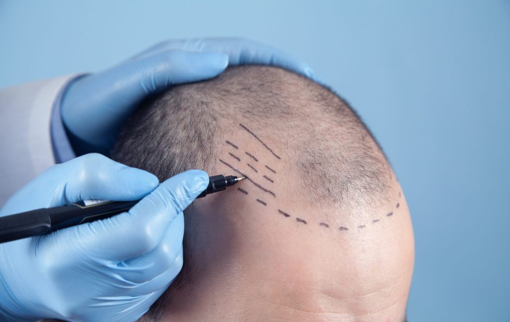 زراعة الشعر بالروبوت ميزات وعيوب