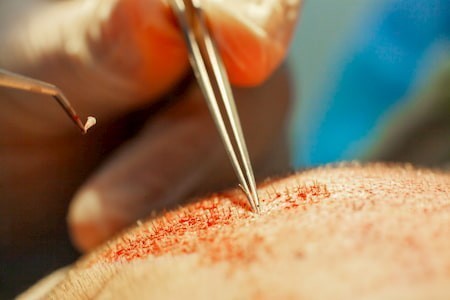 زراعة الشعر في تركيا