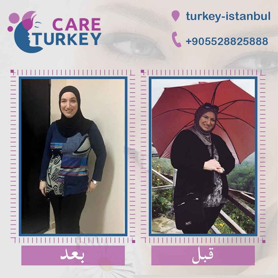 علاج السمنة في تركيا - تكميم المعدة