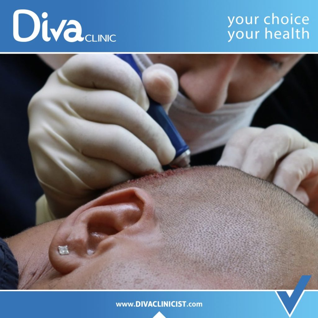 تكلفة زراعة الشعر في تركيا