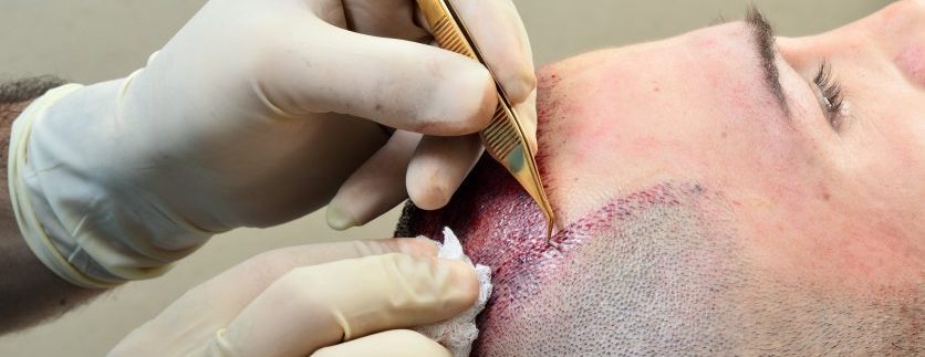 زراعة الشعر في ديفا كلينك