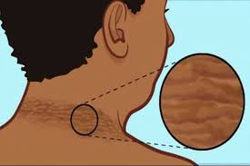 مقاومة الأنسولين