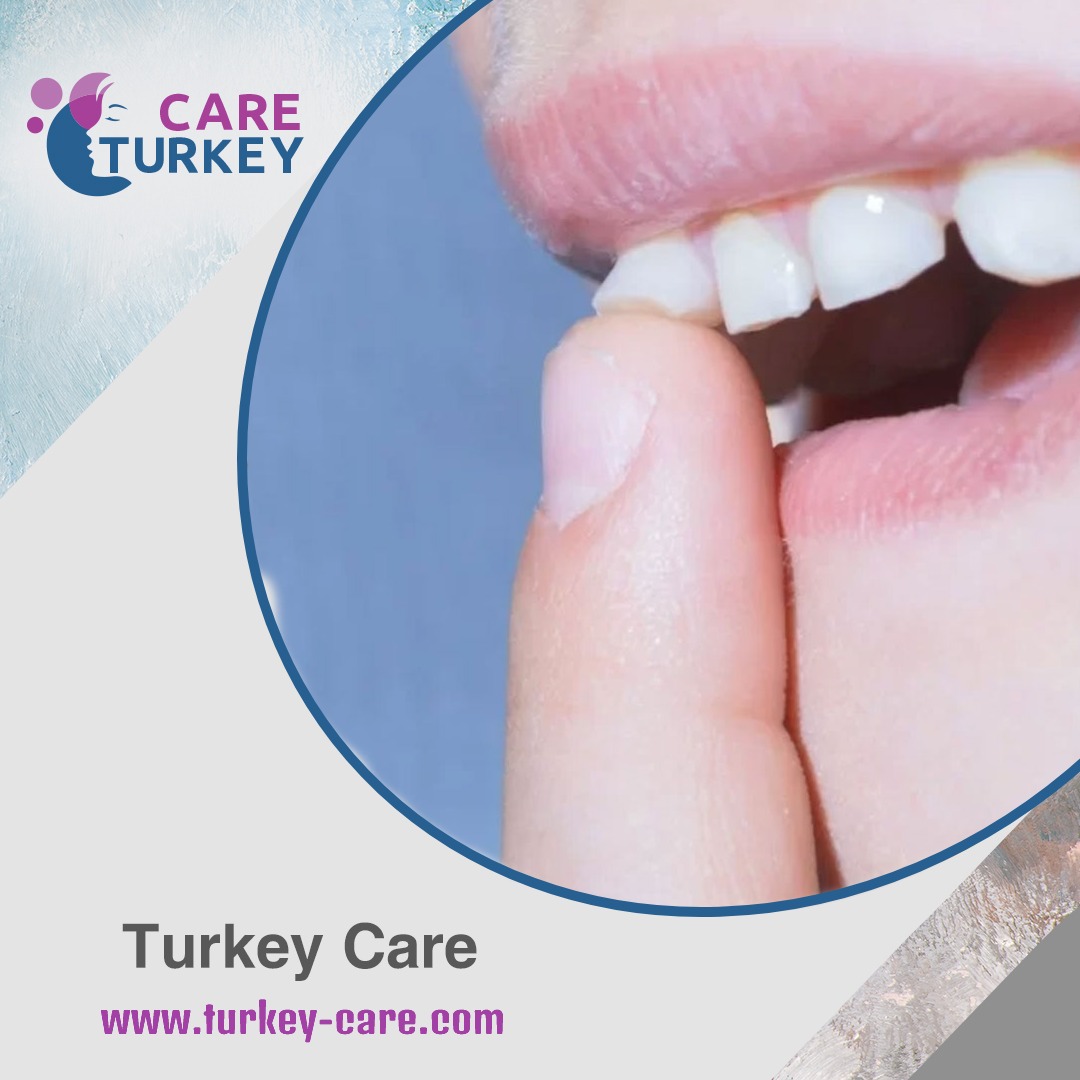 تخلخل الاسنان